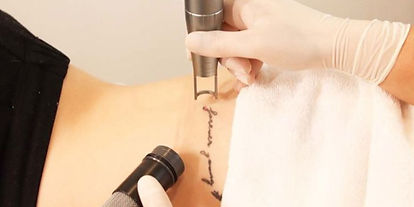 Tattoo Removal Hello Laser Phoenix_edited_edited.jpg