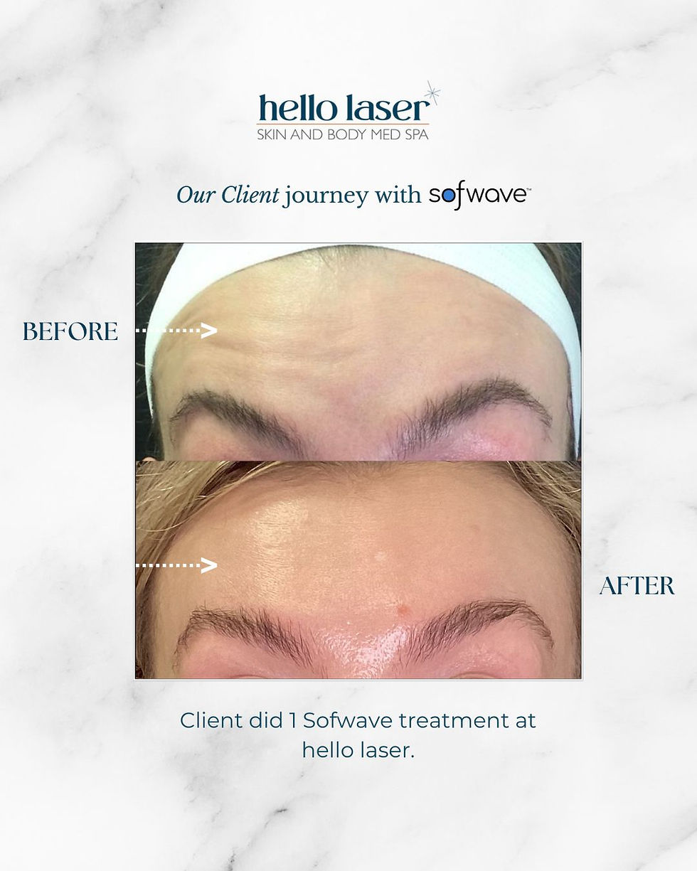 sofwave before and after client results