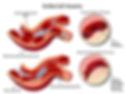 Sickle-Cell-Anemia