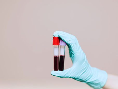 Exame de sangue amplia as possibilidades de diagnóstico precoce do Alzheimer
