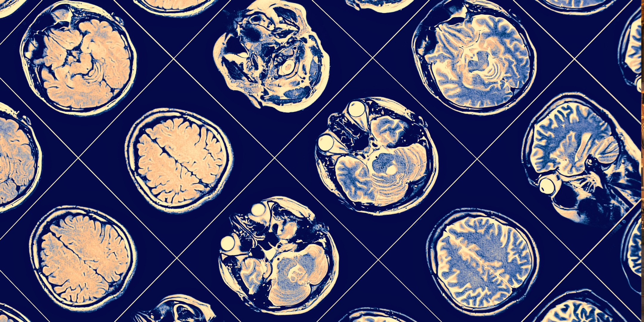 Neurotechnology and TIPSS | SPRITE+ Hub
