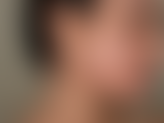Acne Treatment in Christchurch: What's Actually Causing It and How to Clear It