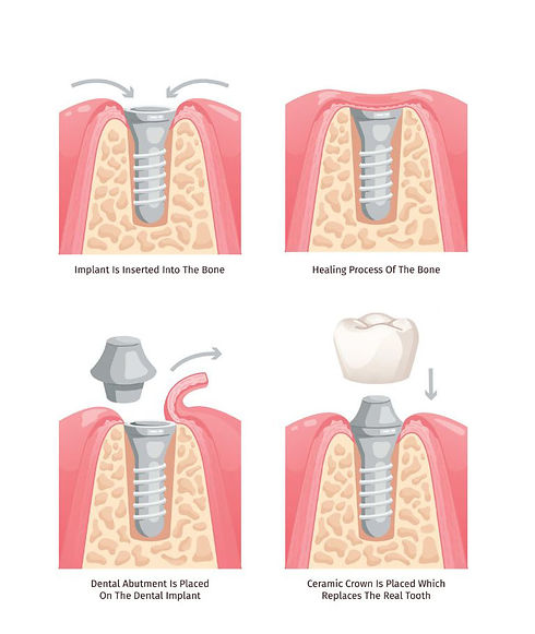 Implant Process 4b.jpg