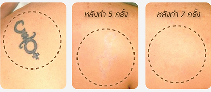 ลบรอยสัก3.png
