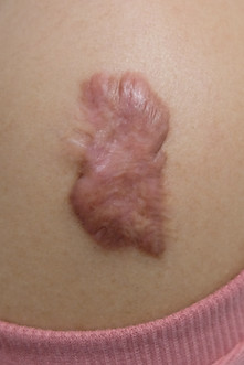 keloid