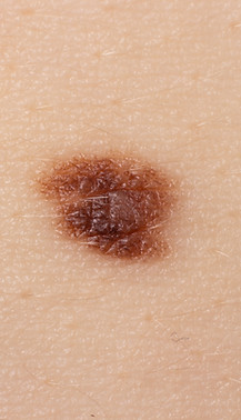 close-up-mole-human-skin.jpg
