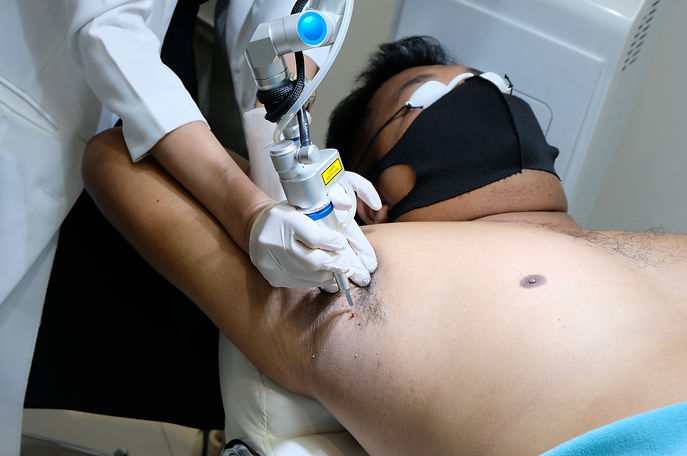 skintag laser by doctor