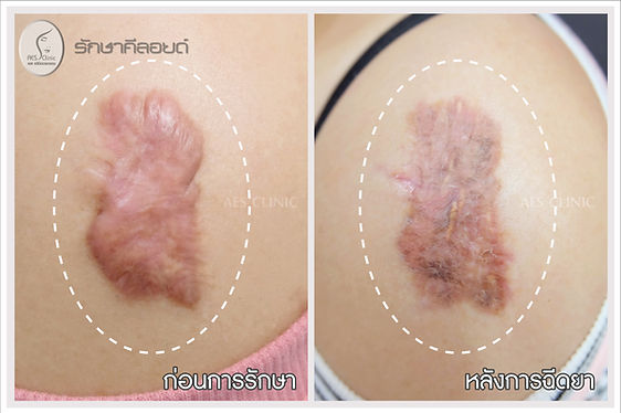 keloid treatment
