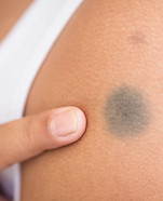 macro-black-birthmark-skin.jpg