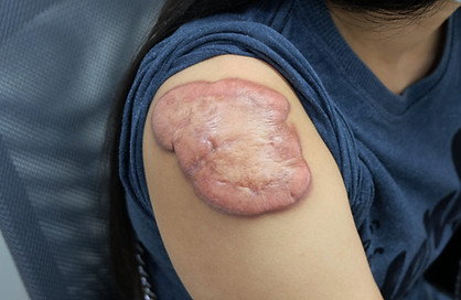 keloid