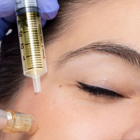 Why you should try the Platelet Rich Fibrin (PRF) Facial