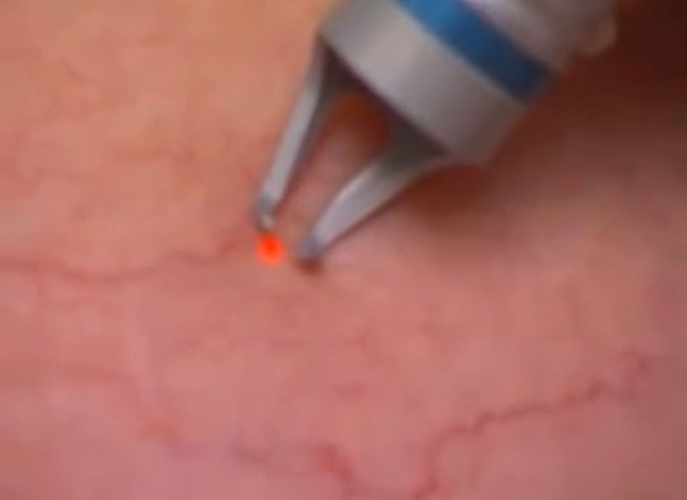 Vascular laser treatment for broken capillaries image
