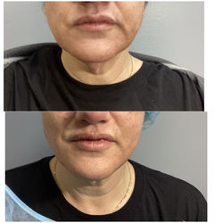 Aptos thread lift before and after