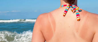sunburn