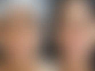 Ácido hialurônico e Rinomodelação: harmonia e definição sem cirurgia