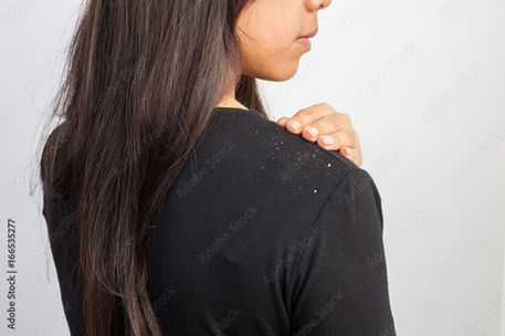 DANDRUFF 