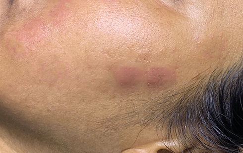 Clear Skin - one week after treatment