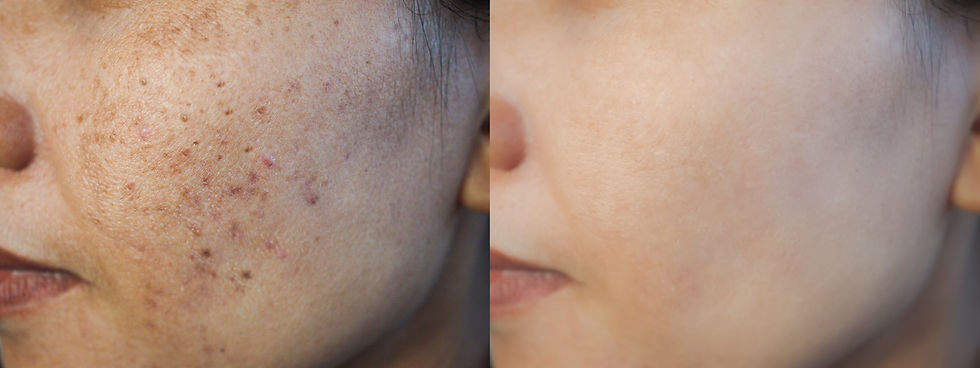 Image before and after dark spot scar acne and melasma pigmentation skin facial treatment