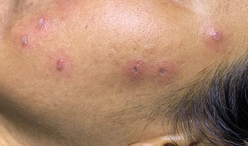 Acne Just after Clear Skin Laser Treatment - 23.09_edited.jpg