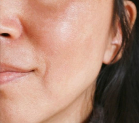 melasma - before & after treatment_edited_edited_edited.jpg