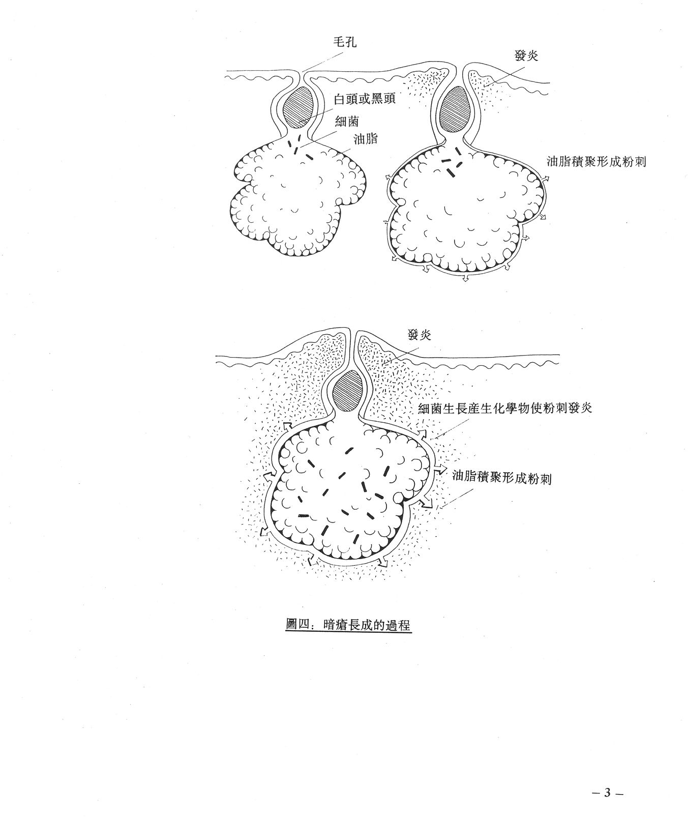 Chinese Acne Information Drleeinfosite Chinese Acne Information Drleeinfosite