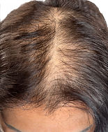 Avant tricpoigmentation, calvitie féminine 