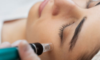 microneedling