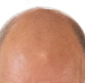 NEW HAIRLINE