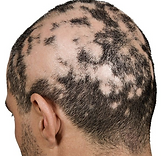ALOPECIA.