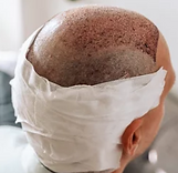 HAIR TRANSPLANT
