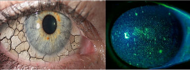 Dryeye3.jpg