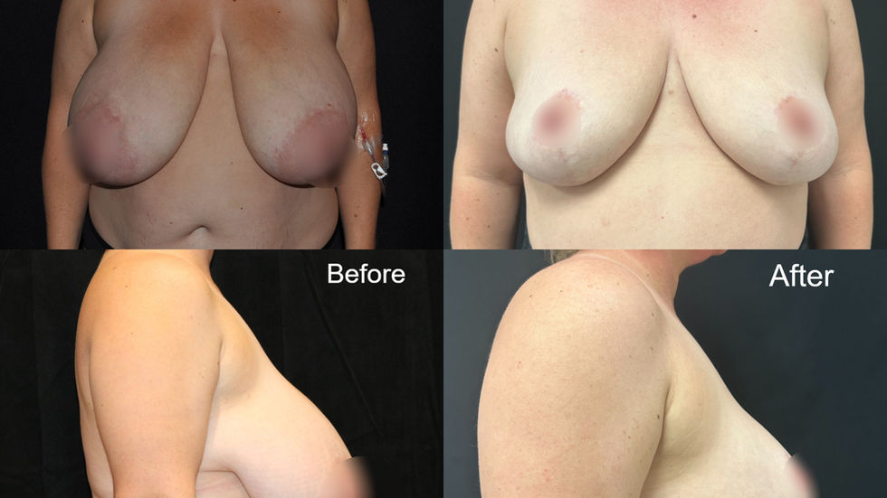 Breast Reduction