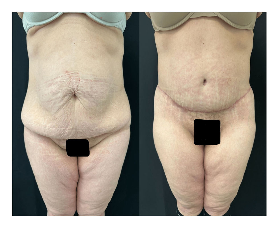 2025.02.12 Lower Body Lift - All Media NO sm (3)