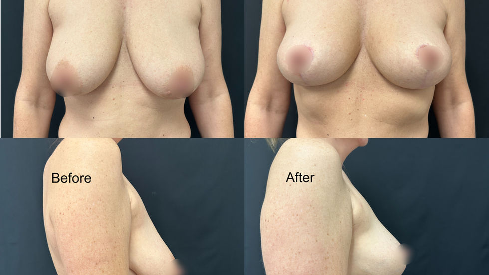 Mastopexy (Breast Lift)