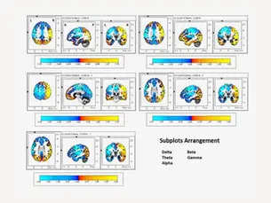 Neural Connectivity Changes to tACS: A Preliminary eLORETA EEG Study