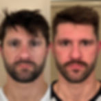 mens-botox-results-denver-colorado-scaled.jpg