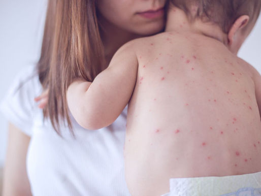 Sarampión en México se cobra la vida de un bebé 