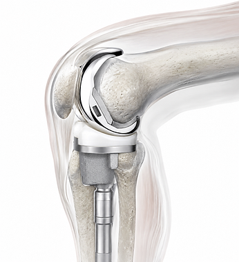 Revision Knee Replacement sistemi femoral komponent ve tibial insert