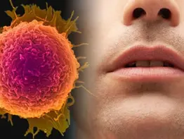 Oral Kavite Malign Neoplazmı (Ağız-Dudak Kanseri) - Keytruda İlaç İçin Kazandığımız Olumlu Dava Sonucu 