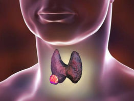 Tiroid Bezi Kanseri - Lenvima ( Lenvatinib ) İlaç İçin Kazandığımız Olumlu Davanın Sonucu 