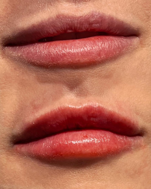 Natural lip enhancement before and after in Harlingen TX