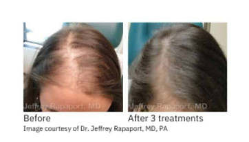 prp hair loss before and after,