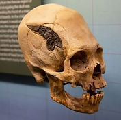 ancient skull with a metal plate