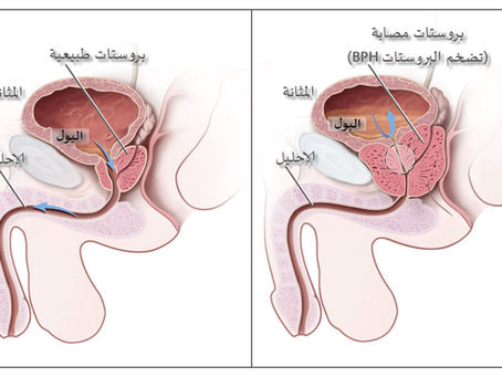 علاج تضخم البروستات تقنية الريزوم والتجريف مع الدكتور أنس العبيدي