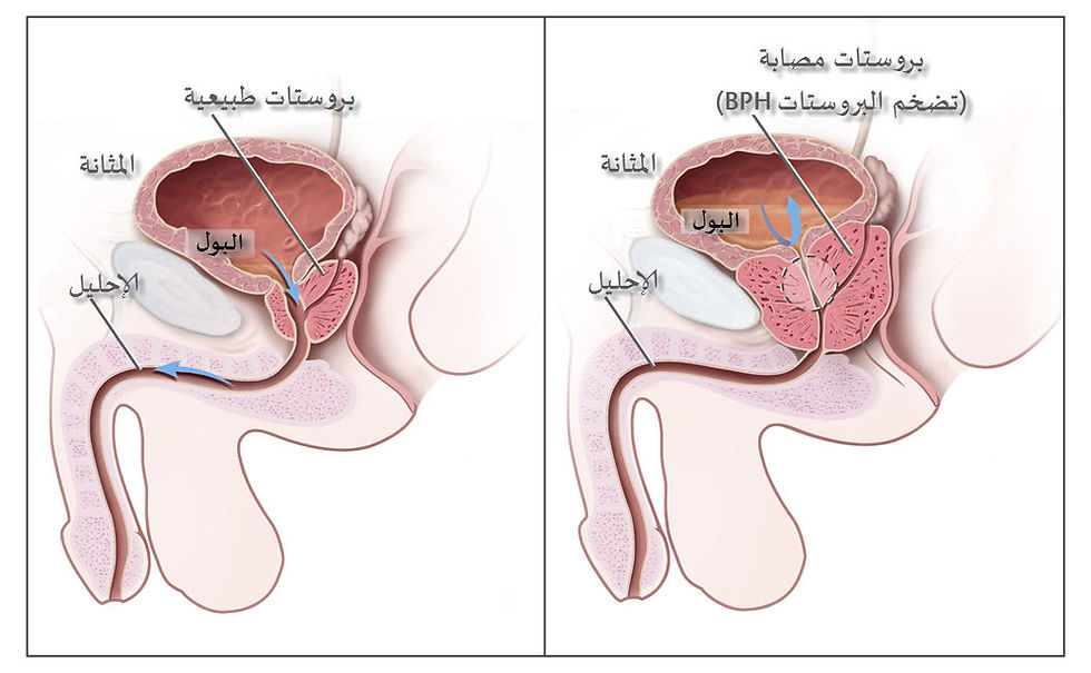 علاج تضخم البروستات تقنية الريزوم والتجريف مع الدكتور أنس العبيدي