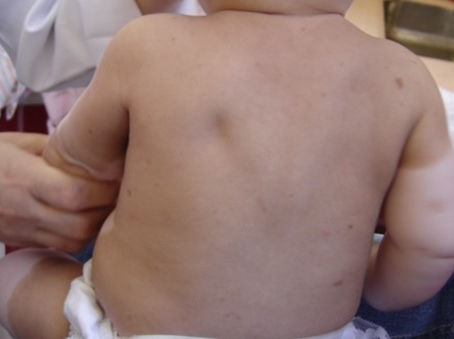 Máculas acrômicas congênitas