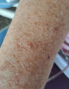 Skin lesion sample for skin cancer checks and minor removals at Doctors@HelderbergCentre