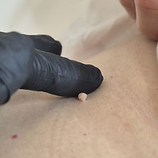 An image of a skin tag