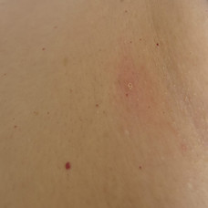 An image showing healthy skin post skin tag removal treatment