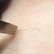 An image of a hair being removed post treatment